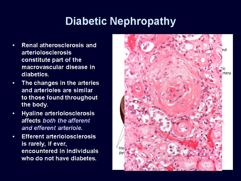 Diabetic Nephropathy Renal atherosclerosis and arteriolosclerosis constitute part of the macrovascular disease in diabetics.